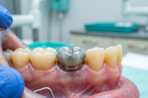 Gray Appearance After Dental Implants