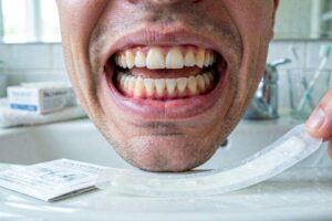 Side Effects of Teeth Whitening Strips