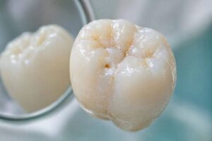 What Does Small Tooth Decay Look Like?