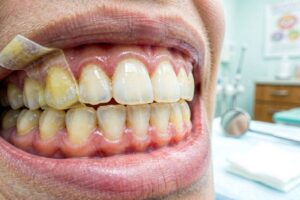 What Happens When You Leave Teeth Whitening Strips on Too Long