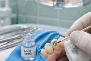 What Is Silver Nitrate In Dentistry?