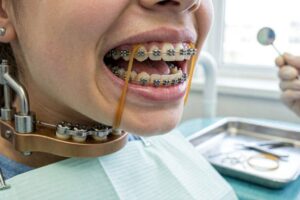 What Is Used In Braces For An Overbite?