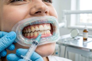 What Is Used to Hold Tooth-Whitening Gel on the Teeth?