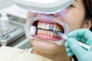 What Is the Blue Gel for in Teeth Whitening?