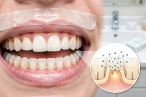 Why Do My Teeth Burn After Whitening Strips?