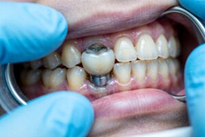 Why Is My New Dental Implant Greyish?