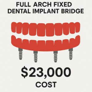 full arch fixed dental implant bridge cost