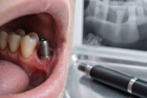 Can Vaping Lead To The Failure Of Dental Implants?
