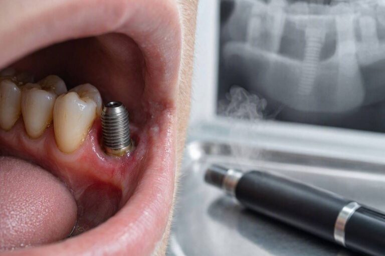 Can Vaping Lead To The Failure Of Dental Implants?