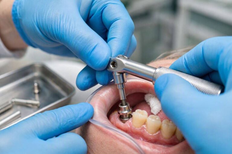 How To Tighten The Screw On A Dental Implant?